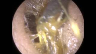 Sticky Ear Wax Removal With quotEar Spoonquot  Mr Neel Raithatha The Hear Clinic [upl. by Ralyt]