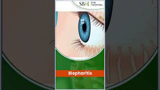 Blepharitis  SBH Hospital  What Is Blepharitis  Chhattisgarh [upl. by Nuahsed]