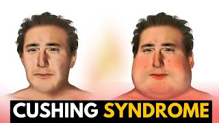 Cushing Syndrome Causes Signs and Symptoms Diagnosis and Treatment [upl. by Zetnas]