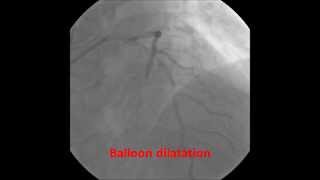 PCI LCX Resolute Integrity Stent [upl. by Oironoh35]