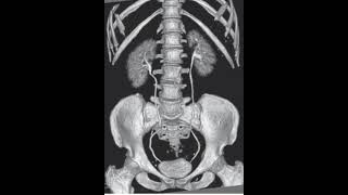 CT Urography  Post Processed urology ct radiology xray shorts video viralvideo trending [upl. by Ylekalb]