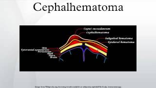 Cephalhematoma [upl. by Aicilyhp]