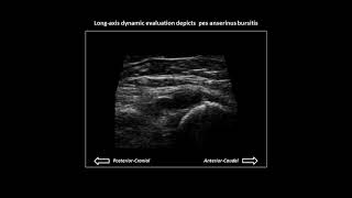 Pes anserinus bursitis on knee ultrasound case 2 [upl. by Susana]