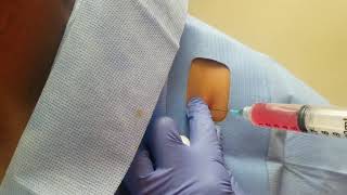 See how Dr Pickens does PRP Injections for Shoulder Pain [upl. by Carlton519]