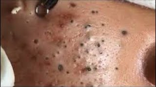 Big cystic Acne Blackheads Acne treatment Relaxing Satisfying video 2021 [upl. by Nodnarb]