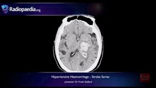 Stroke Hypertensive haemorrhage  radiology video tutorial MRI CT [upl. by Nytram]