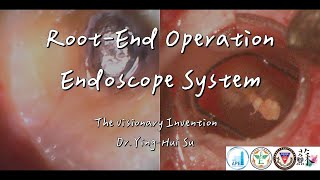 Root End Operation Endoscope System congress of the APEC annual meeting of AEROC [upl. by Nrubliw268]