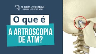 O que é a artroscopia de ATM [upl. by Seedman]