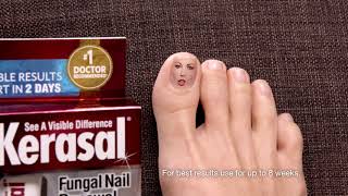 Kerasal® Fungal Nail Renewal™ Improves Appearance of Discolored or Damaged Nails [upl. by Siram]