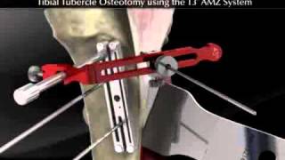 Tibial Tubercle Osteotomy using the T3 AMZ System [upl. by Netniuq609]