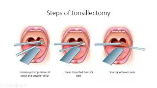 Tonsillectomy  ENT Lecture Series [upl. by Elocaj]