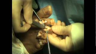 Hammer ToeSmart Toe Surgery  Dr Sherman Nagler  Houstons Foot Doc [upl. by Ehcar]