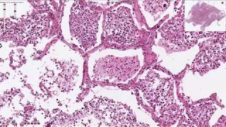 Histopathology  Bronchopneumonia [upl. by Elton]