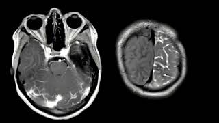 JID January 2024 Cover Radiological Findings in GNAQGNA11 Mosaicism [upl. by Efron915]