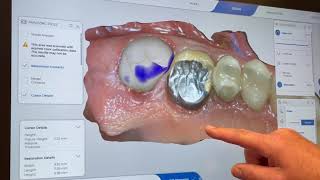 Cerec Tessera Workflow [upl. by Reisfield]