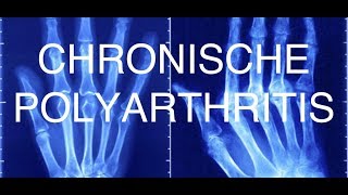 Chronische Polyarthritis [upl. by Velma]