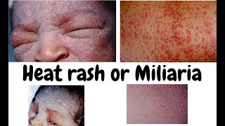 Heat rash Miliaria or Miliariapimples and rash due to heat or warmthDermatology lecture for MBBS [upl. by Gaynor422]