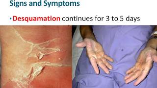 Dermatologic emergencies 1 Staphylococcal Scalded Skin Syndrome [upl. by Shaylah511]