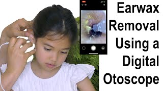 Earwax Removal Using a Digital Otoscope at Home [upl. by Seta]