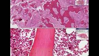 Histopathology BonePaget disease [upl. by Nnaillek678]