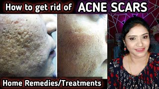 How to get rid of acne scars in detail  Acne Scars Treatments at home [upl. by Ardnat]