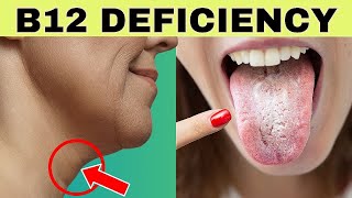 6 Signs of Vitamin B12 Deficiency you Should NEVER Ignore  Metabolic Solutions [upl. by Meibers379]