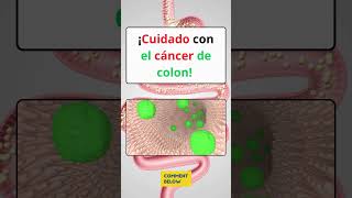 🚨¡CUIDADO SI TIENES UNO DE ESTOS SIGNOS PUEDES TENER CÁNCER DE COLON [upl. by Felisha502]