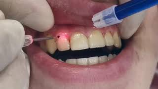 Laser Gingivectomy gum cutting using laser gingival line reshaping after braces removal [upl. by Gardell]