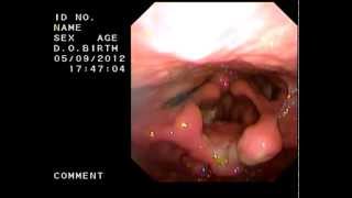 endoscopic epiglottectomy [upl. by Assilak]