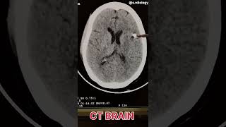 Multidetector CT of mid fractures  ct brain findings [upl. by Inman]