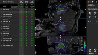 Adaptive Hybrid Surgery—OntheFly Radiosurgery Assessment [upl. by Cochrane]