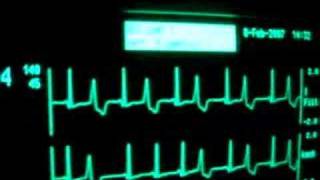 intensive care ecg with extrasystoles [upl. by Suanne]