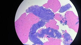 Mediastinal Thymoma with Lung Invasion Diagnosed by EBUSPLBPeribronchialSmall Biopsy25th Video [upl. by Leafar575]