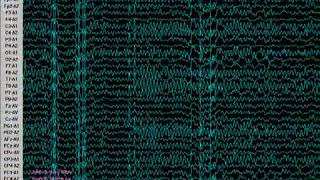 ELECTROENCEFALOGRAMA DE 32 CANALES INTERFAZ A PC EEG KT883200 YouTube 360p [upl. by Albertson]