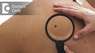 Difference between Melanoma and other skin pigmentations  Dr Rajdeep Mysore [upl. by Rosenwald]