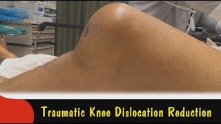 Traumatic Knee Dislocation Reduction [upl. by Salmon]