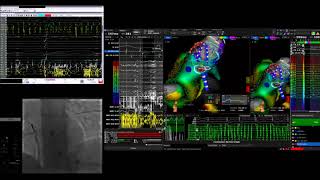 Focal AF ablation with Rhythmia system [upl. by Clifford65]