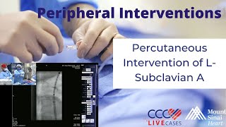 Percutaneous Intervention of LSubclavian A  June 26 2013 Live Case Video [upl. by Therine982]