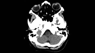 Paraganglioma jugular [upl. by Kcirdet]