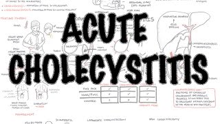 Acute Cholecystitis  Overview signs and symptoms pathophysiology treatment [upl. by Maloney501]