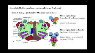 Sectional Anatomy of the Brainstem Clinical brainstem syndromes [upl. by Irrehc592]