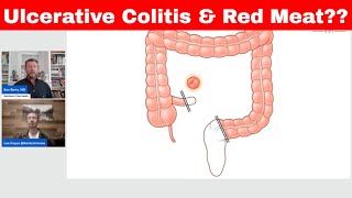 Ulcerative Colitis amp Red Meat Warning KENTCARNIVORE [upl. by Carvey]