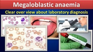 Megaloblastic anemiaClear over view about laboratory diagnosis [upl. by Frolick]