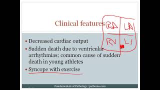 8 6 Cardiomyopathy 8 7 Cardiac Tumors [upl. by Nickola]