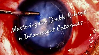 How to Master the Double Rhexis Technique for intumescent cataract  a video guide [upl. by Artep844]