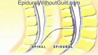 Animation of Difference Between Epidural and Spinal Techniques [upl. by Socrates]