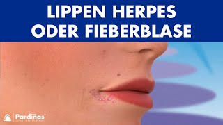 LIPPEN HERPES – Was ist eine Fieberblase und wie wird sie übertragen © [upl. by Eidnim814]