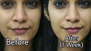 How to Remove Pimple amp Acne Scars  Home Remedies For Pimple Removal  Super Style Tips [upl. by Edrei]