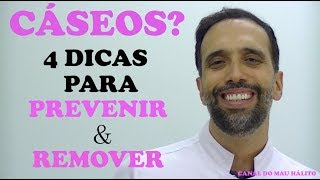 4 DICAS para PREVENIR e REMOVER CÁSEOS [upl. by Latsirhc81]