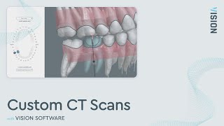 CBCT Dental Scan  CBCT Analysis in VISION [upl. by Wat]